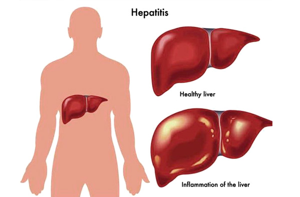 Cho cháu hỏi thế nào là bệnh viêm gan virus ạ? Cách nhận biết ra sao? 1 hoi dap nhan dien viem gan sieu vi