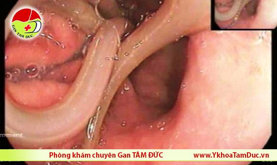 noi soi giun dua 15cm trong da day benh nhan o ha noi