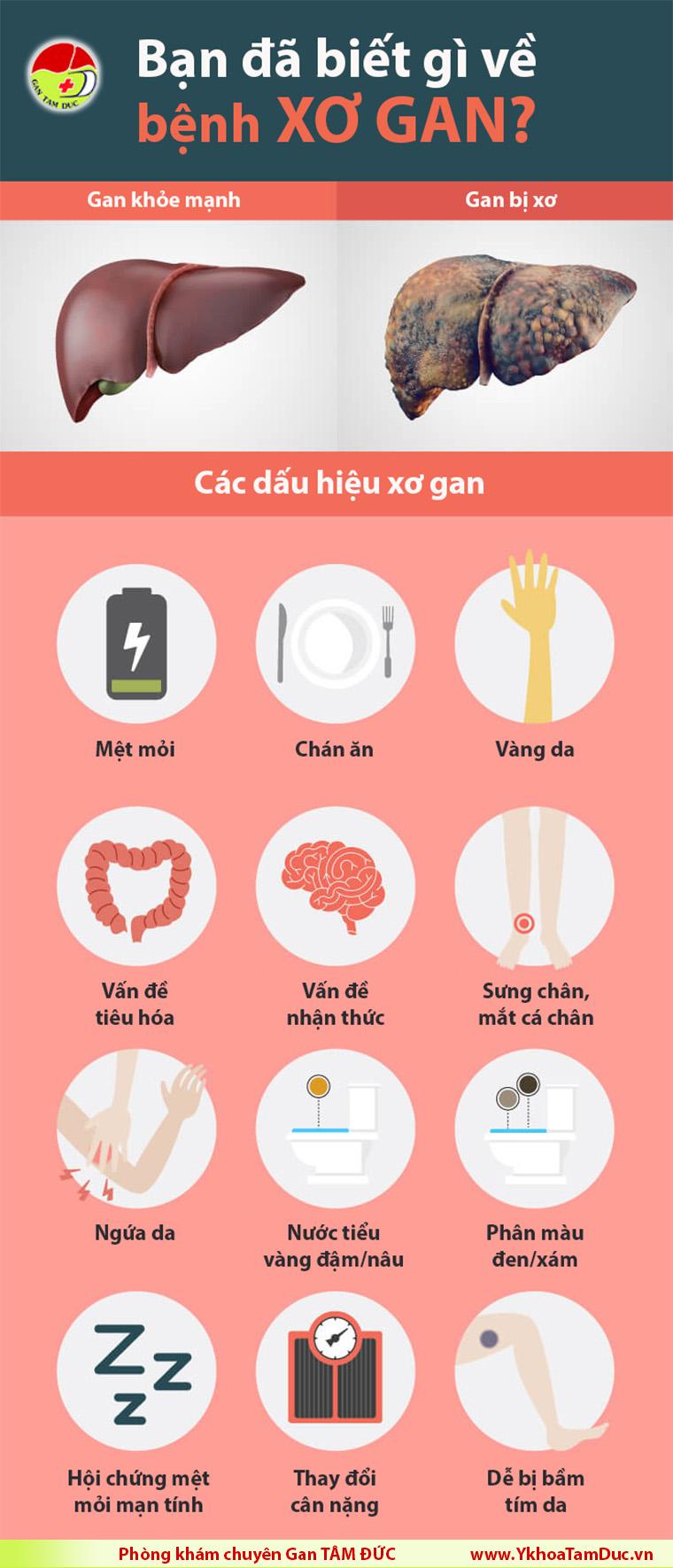 infographic các dấu hiệu xơ gan giai đoạn sớm