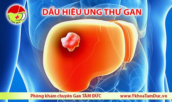 Cảnh giác các dấu hiệu ung thư gan 2 dau hieu ung thu gan trieu chung ung thu gan