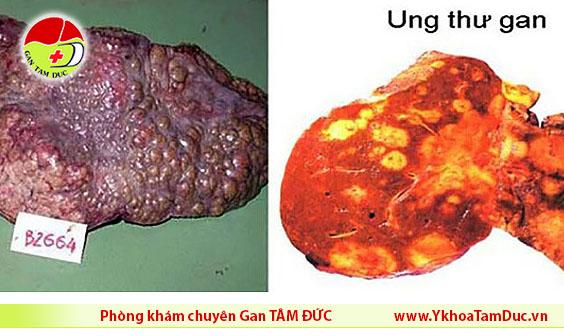 Vì sao ung thư gan vọt lên vị trí đầu bảng ? 3 ung thu gan hinh anh gan bi ung thu