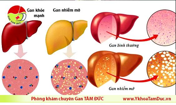 gan khoe manh binh thuong va gan nhiem mo
