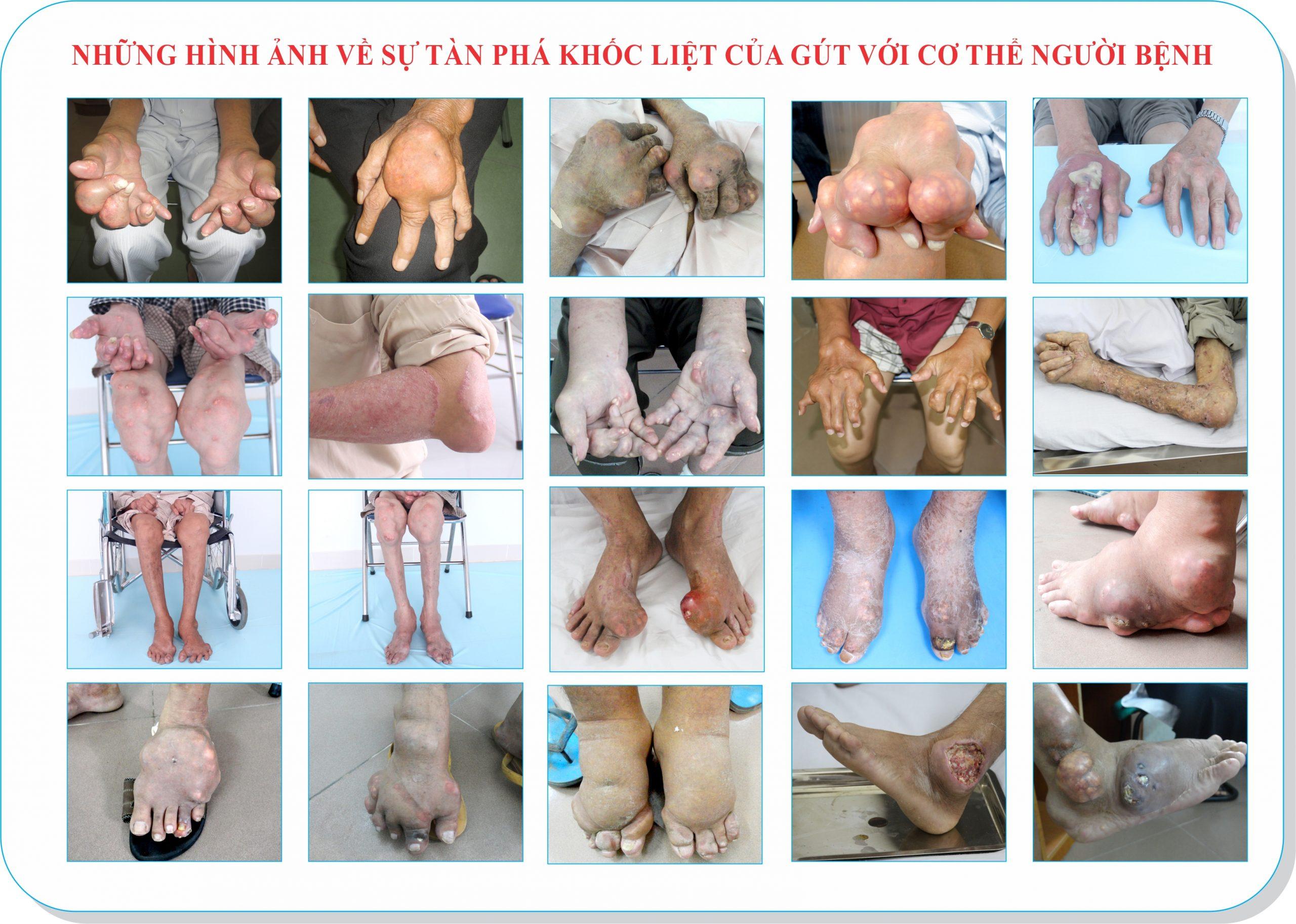 Bệnh Gút có nguy hiểm không 7 1 Hinh anh bien chung scaled