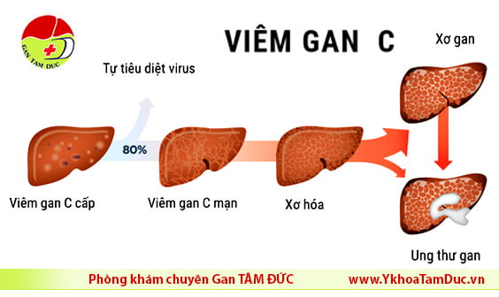 4 giai doan viem gan c 4 stages hcv