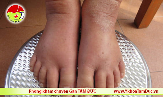 Viêm gan C f4 là gì? 3 ban chan bi sung phu xo gan f4