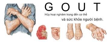 Bệnh Gút mắt cá chân 3 Benh gut anh huong den suc khoe