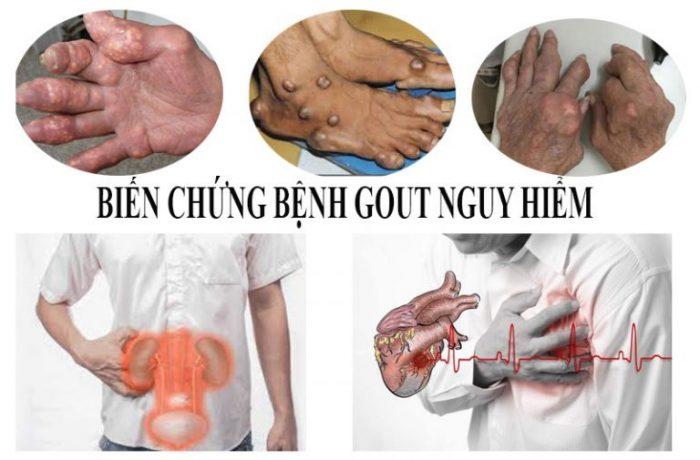 Bệnh Gút lâu năm 6 Benh gut nguy hiem nhu the nao