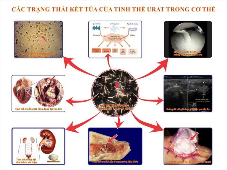 Bệnh Gút ảnh hưởng đến sức khỏe 4 Moi lien quan giua viec tang Acid uric va benh gut