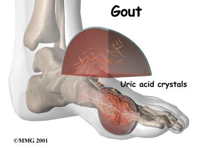 Bệnh Gút có biểu hiện gì? 6 Benh gout va axit uric co moi lien quan chat che voi nhau 1