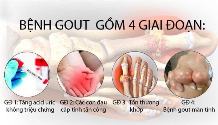Bệnh gút và triệu chứng 7 Benh gut co may giai doan