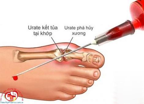 Bệnh Gút triệu chứng 9 Benh gut co mo duoc khong KN