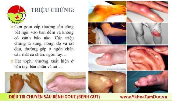 Bệnh gút và triệu chứng 6 Benh gut co mo duoc khong trieu chung