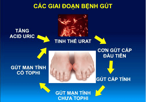 Benh gut giai doan cuoi