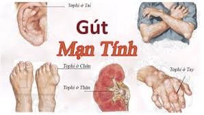 Bệnh Gút và viêm khớp 6 gout man