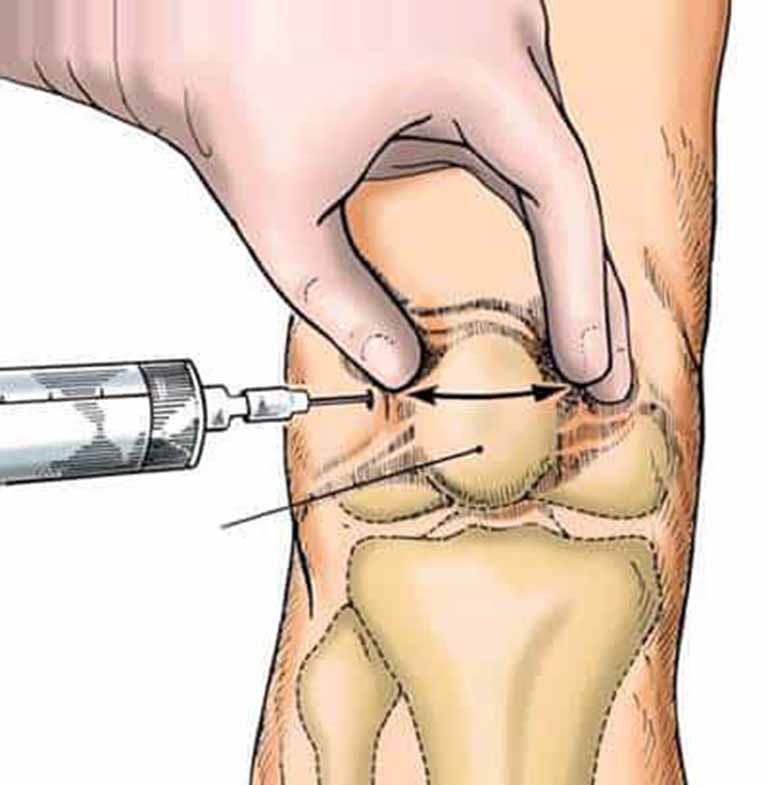 Bệnh gút xét nghiệm gì 9 Benh gut xet nghiem gi k