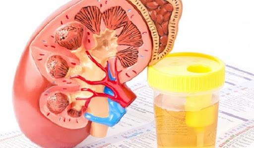 Bệnh gút xét nghiệm gì 8 Benh gut xet nghiem gi nieu