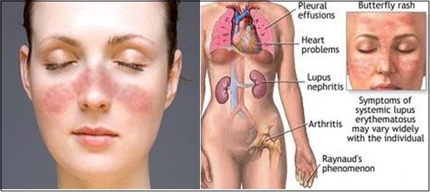Benh lupus ban do v