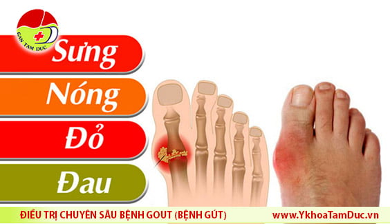 bieu hien cua benh gut