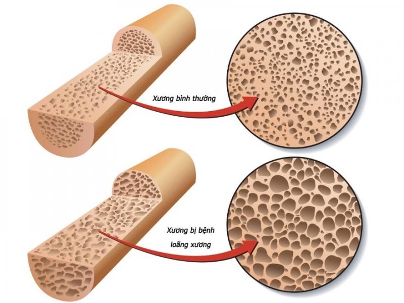 Phân biệt thoái hóa khớp và loãng xương 4 hinh anh loang
