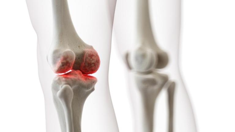 Phân biệt thoái hóa khớp và loãng xương 3 hinh anh thoai hoa khop