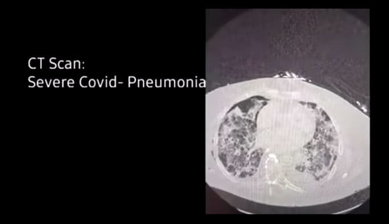 Hình ảnh CT-Scan cho thấy phổi của người bệnh CIVID-19 bị tổn thương như thế nào 13 hinh anh ct-scan phoi benh nhan covid-19