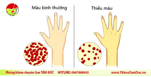 Viêm gan C và thiếu máu: Những điều cần lưu ý 2 bieu hien thieu mau