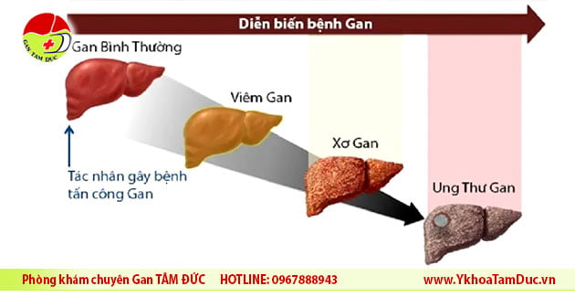 Gan xơ hóa F1 là gì ? 2 dien tien cua benh gan xo gan ung thu gan