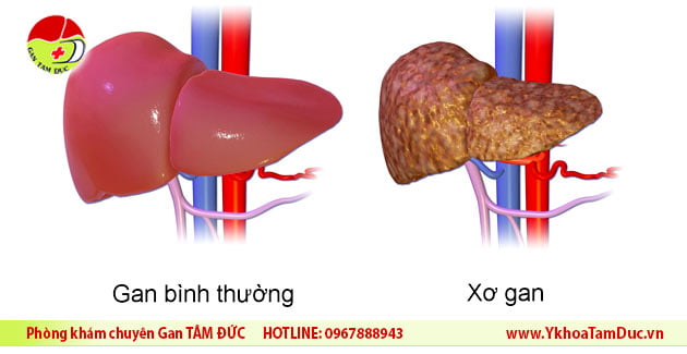 Những điều cần biết về xơ gan 2 gan bi xo hinh anh xo gan