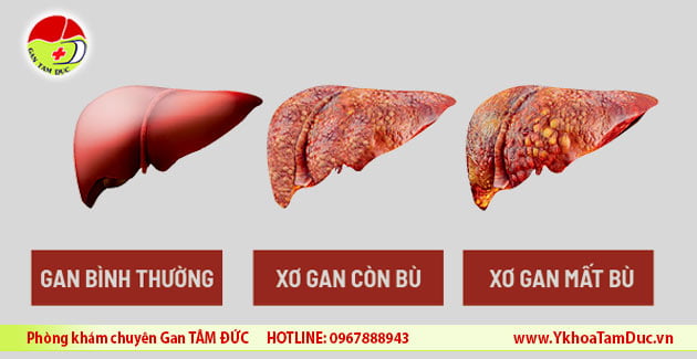 Miễn phí đo Fibroscan tầm soát gan nhiễm mỡ và xơ gan 1 hinh anh xo gan con bu xo gan mat bu