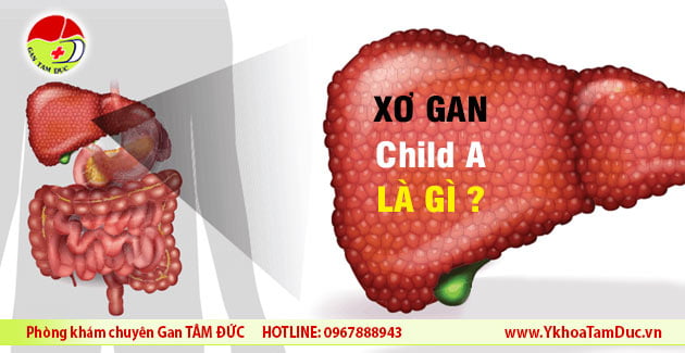 xo gan child a la gi