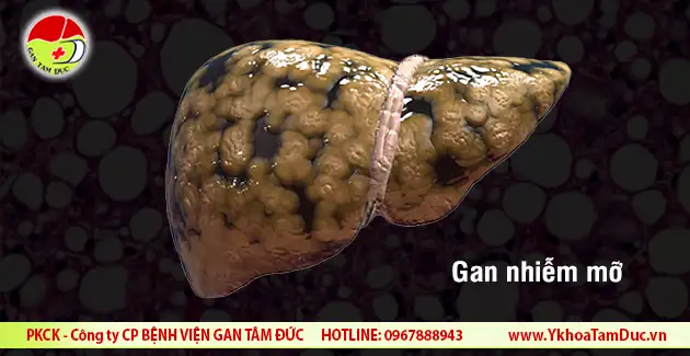 Tất tần tật về cách trị gan nhiễm mỡ tại nhà 1 gan nhiem mo hinh anh gan nhiem mo