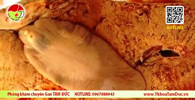 【Cảnh báo】Nhiều người bị áp xe gan do sán lá gan lớn tại TP.HCM 3 hinh anh san la gan lon gan tam duc