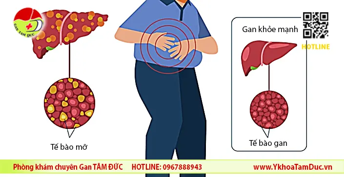 Gan nhiễm mỡ độ 2 nguy hiểm không