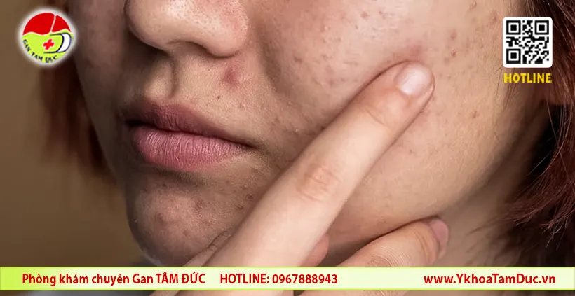 dấu hiệu gan yếu trên mặt