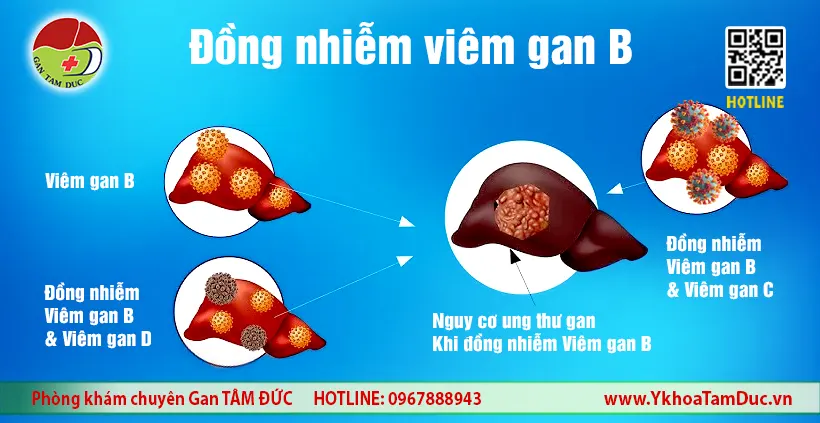 Đồng Nhiễm Viêm Gan B: Chuyên Gia Phân Tích Nguy Cơ & Lộ Trình Điều Trị Hiệu Quả 2 Đồng nhiễm viêm gan B làm tăng nguy cơ ung thư gan