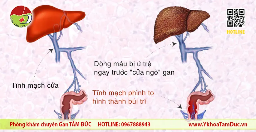 Viêm Gan có "lan" sang Trĩ không? Chuyên gia giải đáp 5 Sơ đồ so sánh cơ chế xơ gan gây bệnh trĩ, minh họa dòng máu ứ trệ tại tĩnh mạch cửa làm phình to tĩnh mạch trực tràng.