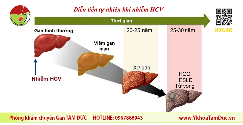 Viêm Gan C Cấp Tính Có Chữa Được Không? Giải Đáp Từ Chuyên Gia Gan Mật Với Gần 40 Năm Kinh Nghiệm 2 Sơ đồ diễn tiến tự nhiên của bệnh viêm gan C từ gan bình thường đến xơ gan và ung thư gan