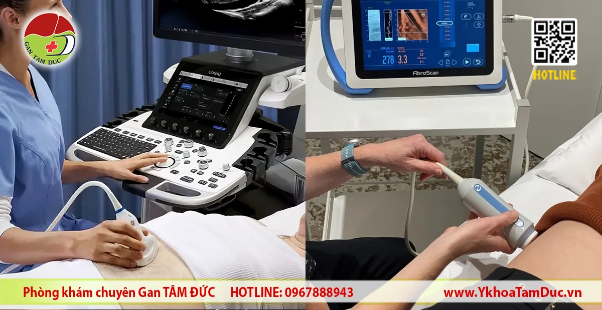 Bác sĩ thực hiện siêu âm gan và đo Fibroscan để đánh giá gan nhiễm mỡ