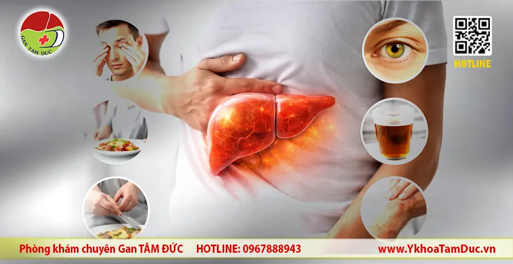 Người đàn ông ôm vùng hạ sườn phải minh họa triệu chứng men gan cao và tổn thương gan