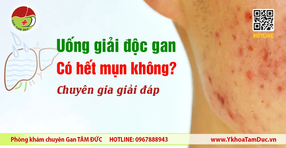 Hình ảnh da bị mụn kèm tiêu đề uống giải độc gan có hết mụn không