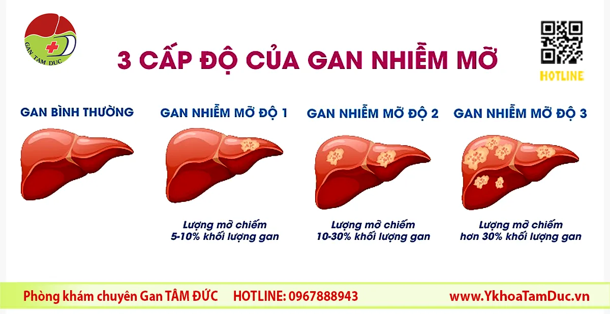 Gan nhiễm mỡ độ 3 có chữa khỏi được không? 1 Minh họa các cấp độ gan nhiễm mỡ từ bình thường đến độ 3 dựa trên tỷ lệ mỡ trong gan