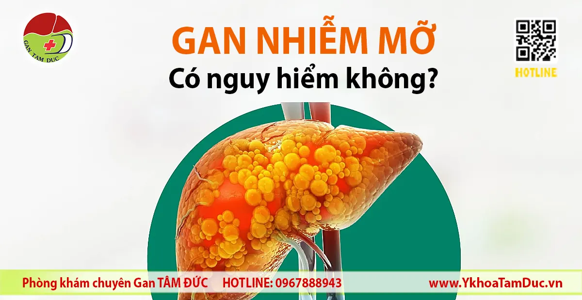 Hình minh họa gan nhiễm mỡ với các hạt mỡ tích tụ trong mô gan