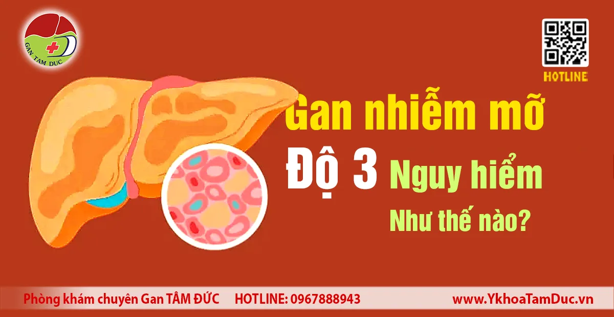 Hình minh họa gan nhiễm mỡ độ 3 với mô gan và tế bào mỡ tích tụ