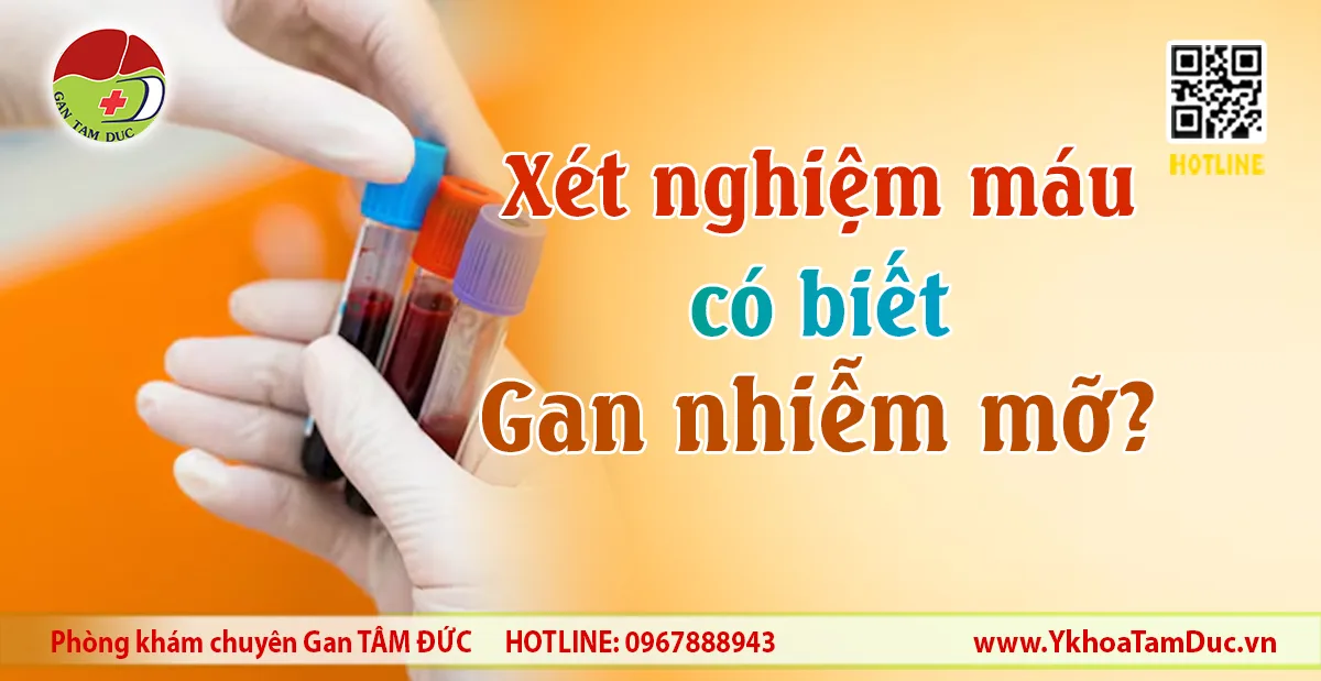 Xét nghiệm máu có biết gan nhiễm mỡ không — Phòng khám Gan Tâm Đức