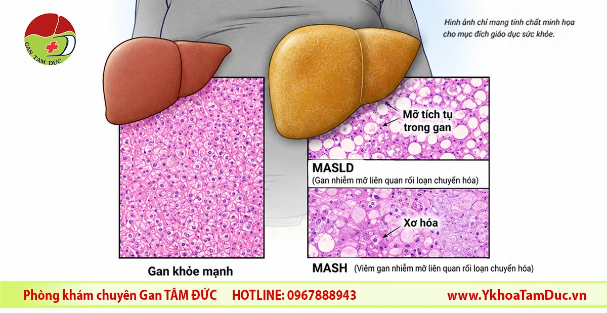 Minh họa so sánh gan khỏe mạnh với gan nhiễm mỡ MASLD và viêm gan nhiễm mỡ MASH, kèm hình ảnh mô học cho thấy tích tụ mỡ và xơ hóa