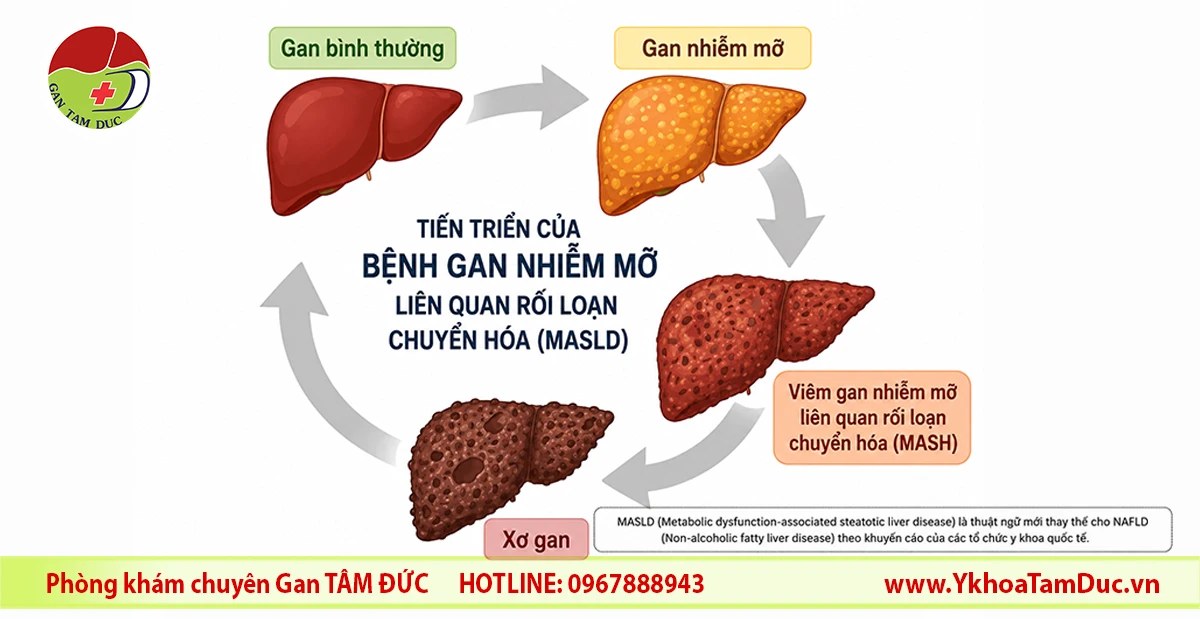 Tự chăm sóc gan nhiễm mỡ (MASLD): Hướng dẫn khoa học và an toàn 7 Sơ đồ tiến triển bệnh gan nhiễm mỡ liên quan rối loạn chuyển hóa từ gan nhiễm mỡ đến viêm gan nhiễm mỡ và xơ gan
