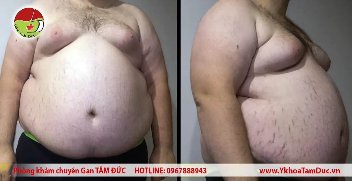 Bụng to có phải bị gan không? Dấu hiệu nào cần đi khám 3 Người đàn ông béo bụng với vòng bụng lớn ở tư thế nhìn trực diện và nghiêng, minh họa tình trạng bụng to do tích mỡ vùng bụng.