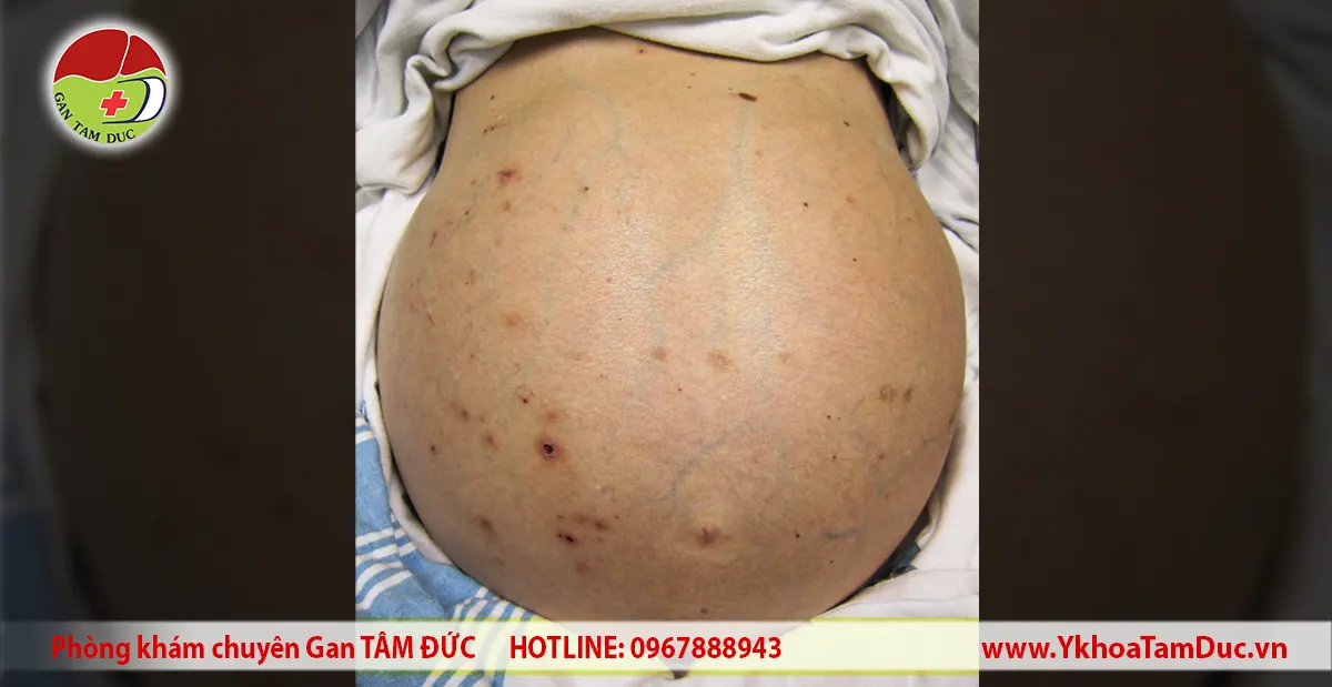 Bụng to có phải bị gan không? Dấu hiệu nào cần đi khám 2 Hình ảnh lâm sàng vùng bụng căng to và tĩnh mạch thành bụng nổi rõ ở người bệnh có cổ trướng liên quan đến xơ gan.