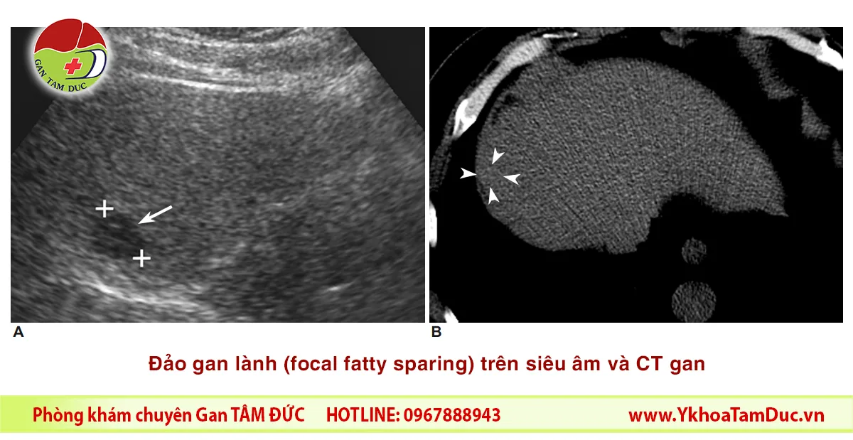 Siêu âm và CT gan minh họa đảo gan lành (focal fatty sparing) trên nền gan nhiễm mỡ. Vùng này có thể xuất hiện như một tổn thương giảm âm trên siêu âm nhưng không phải khối u gan.