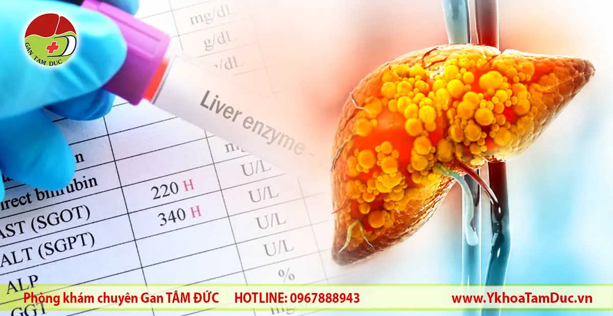 Minh họa gan nhiễm mỡ bên cạnh phiếu xét nghiệm men gan ALT và AST tăng trên xét nghiệm máu